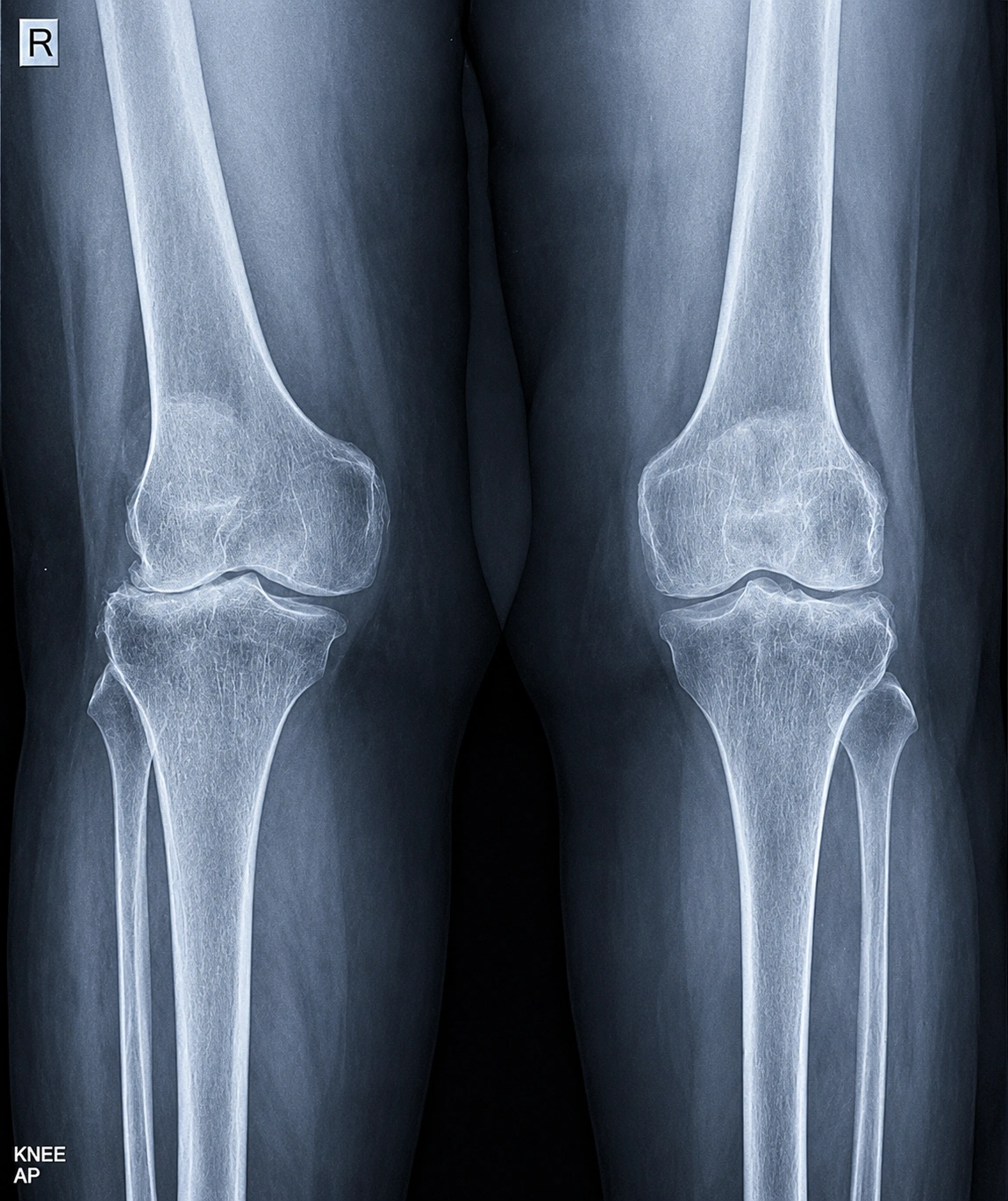 Knee Replacement Case 1 - Pre-Op